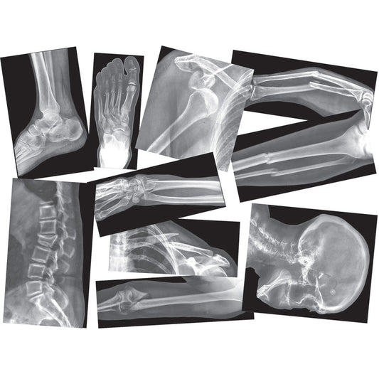 BROKEN BONES X-RAYS